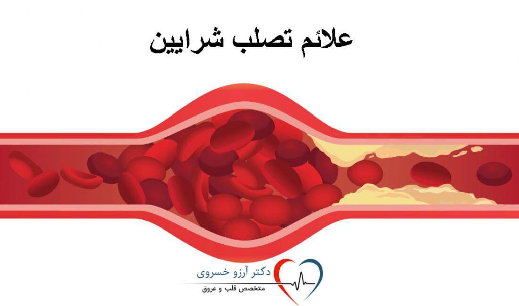 علائم تصلب شرایین