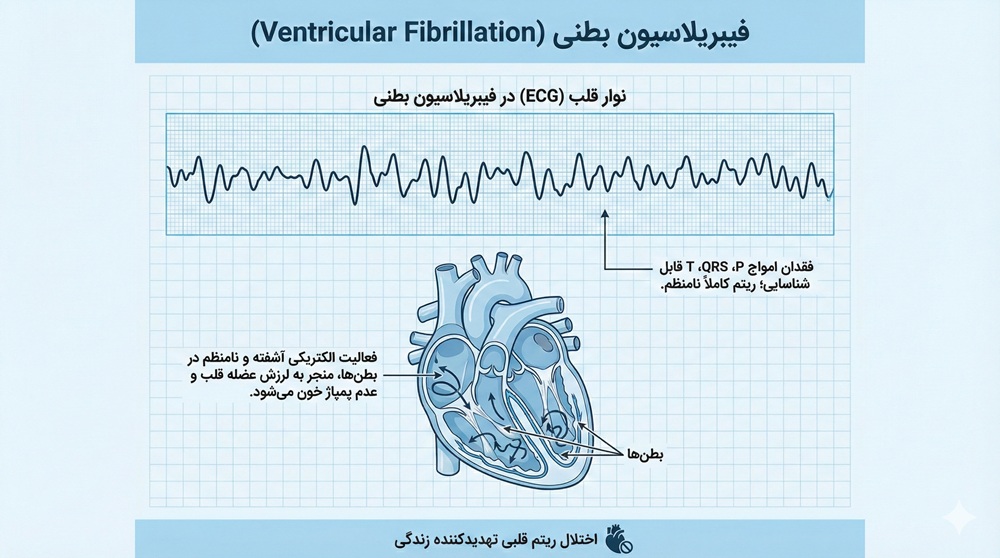 عکس نوار قلب در فیبریلاسیون بطنی