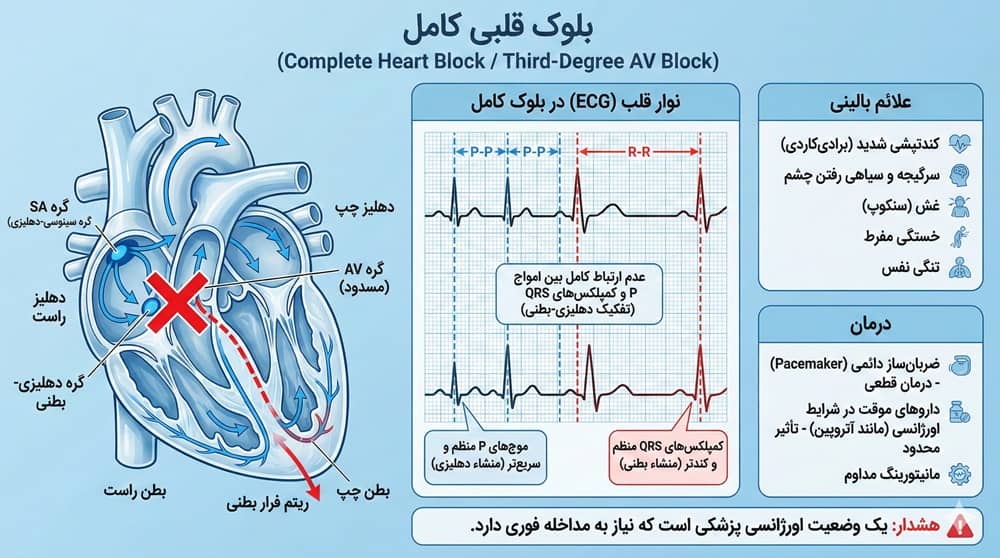 عکس نوار قلب بلوک قلبی کامل