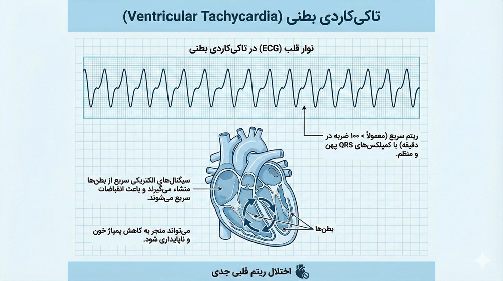 عکس نوار قلب تاکی کاردی بطنی