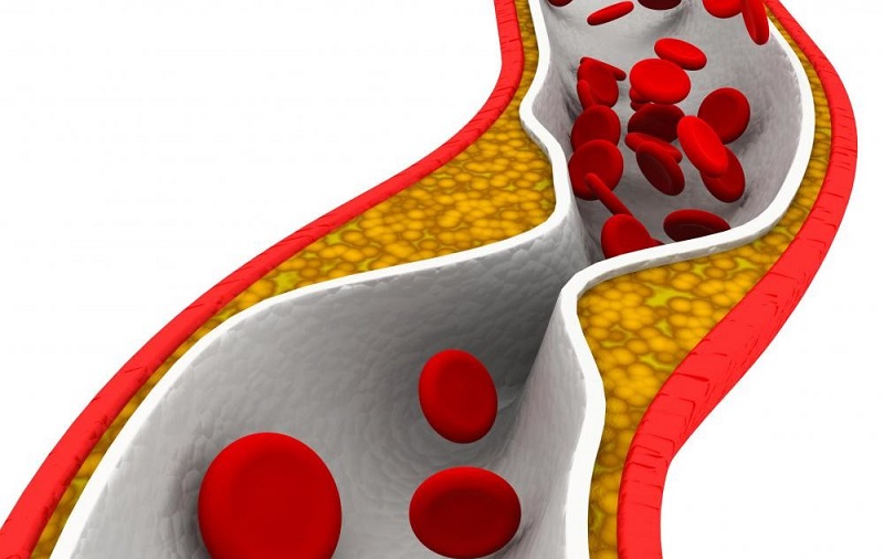 چربی حون بالاتر از 200