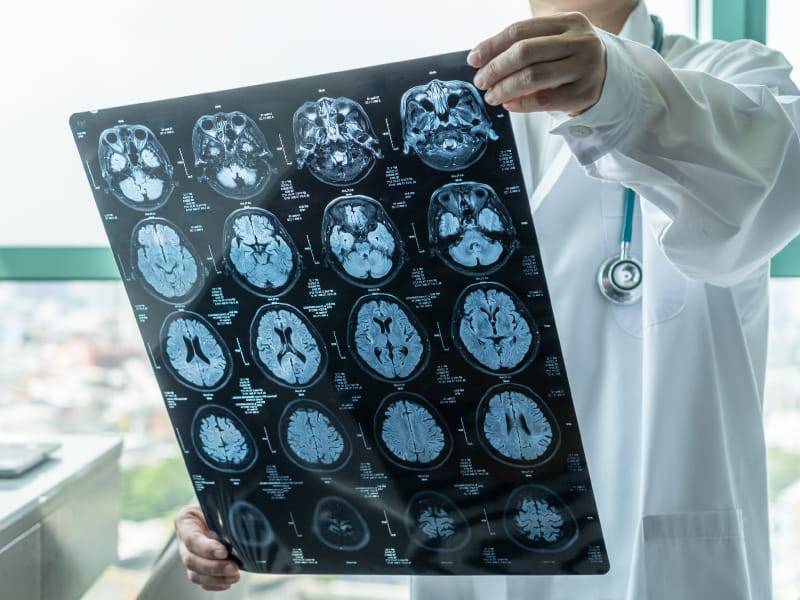 مشکلات مغزی یکی از عوارض فشار خون بالا