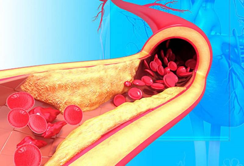 مشکلات عروقی یکی از عوارض فشار خون بالا