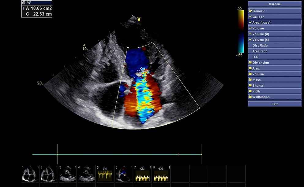 اکو رنگی قلب