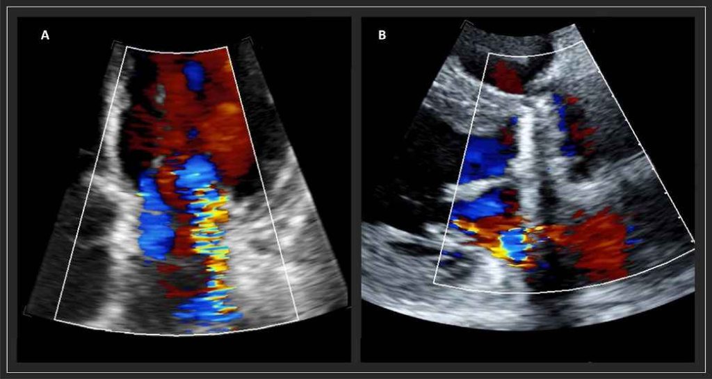 اکو قلب رنگی