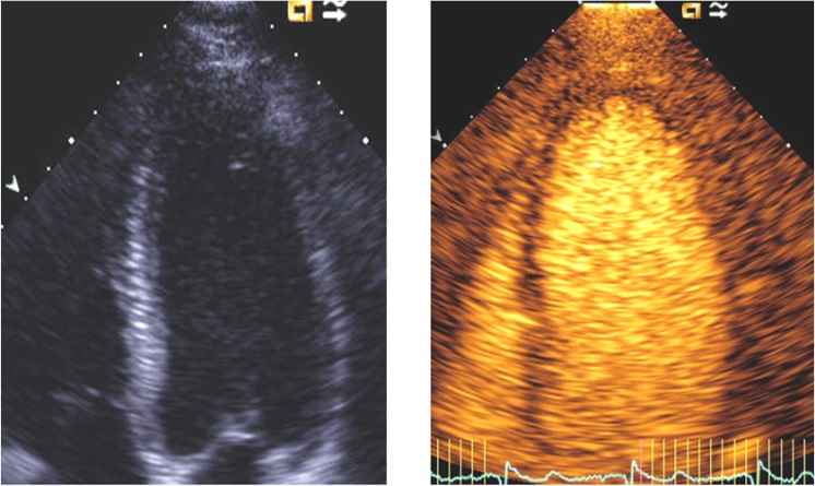 فرق اکو باکنتراست و اکو معمولی