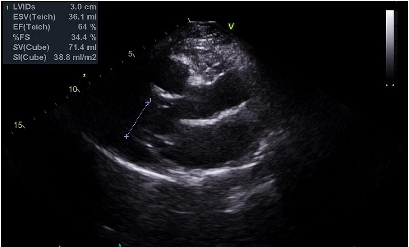 عکس اکو قلب