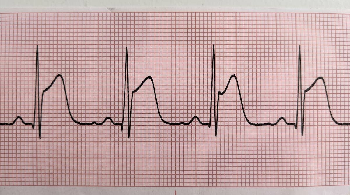 عکس نوار قلب خطرناک سکته قلبی