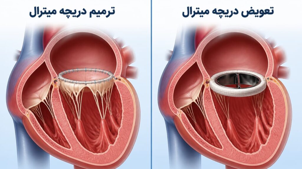ترمیم دریچه یا تعویض دریچه قلب