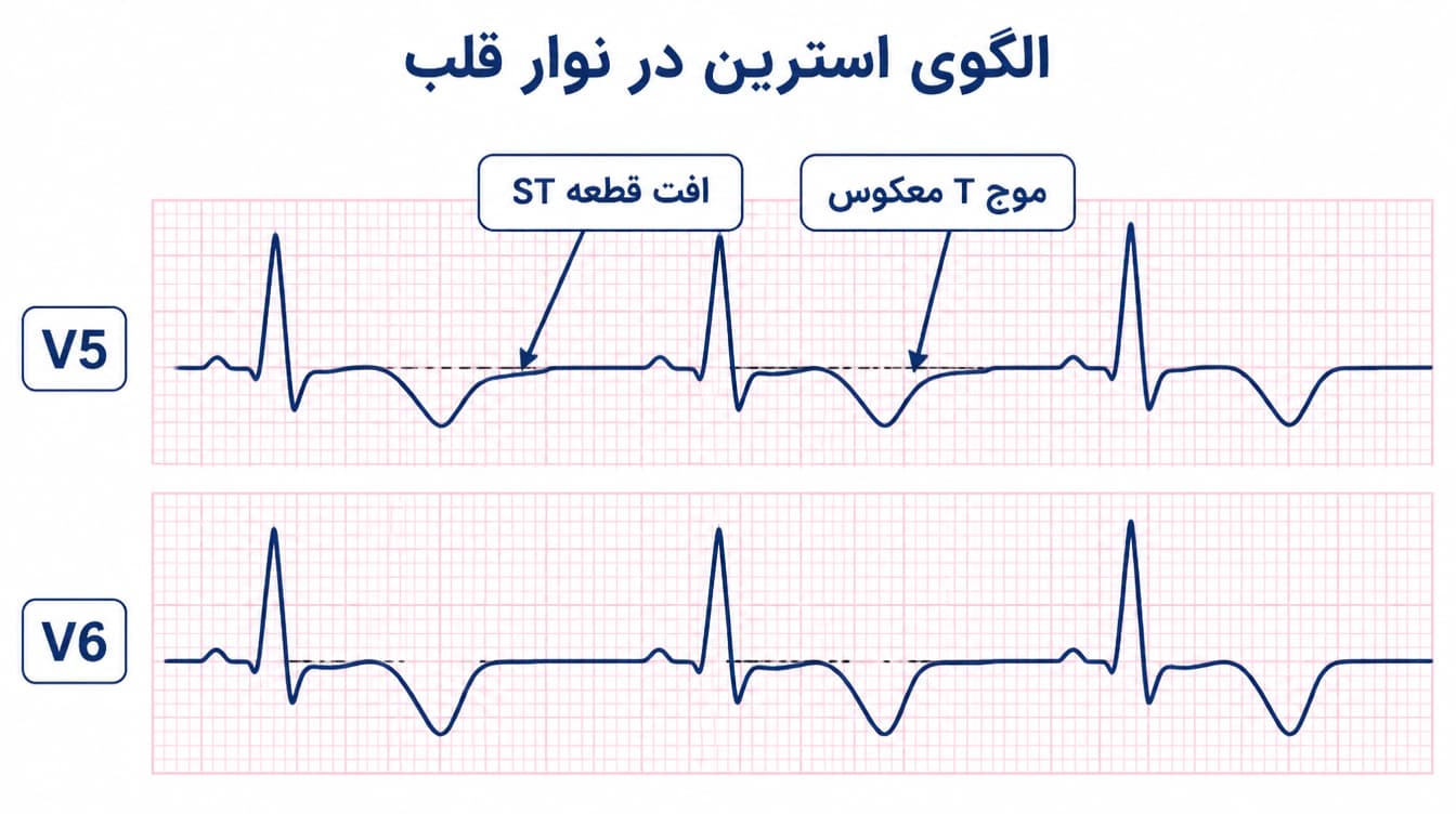 استرین پترن در نوار قلب