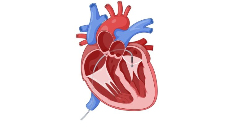 مشکل نارسایی دریچه میترال