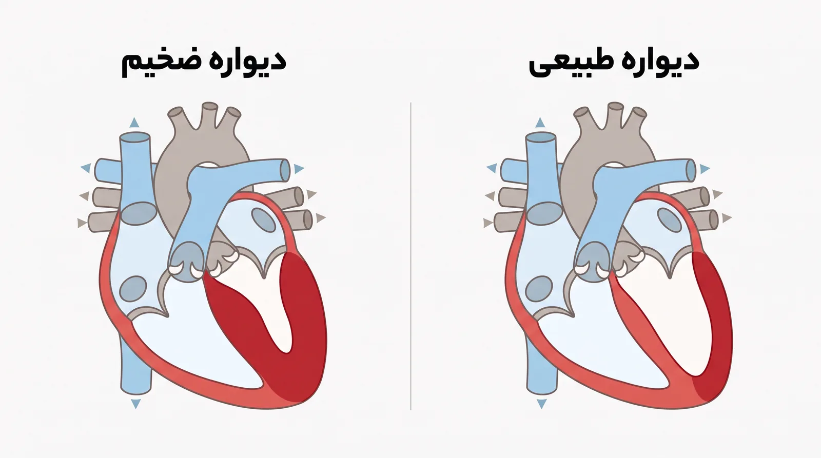 مقایسه‌ی دیواره‌ی طبیعی و دیواره‌ی ضخیم بطن چپ قلب