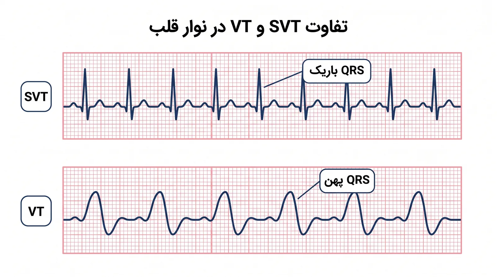 شکل نوار قلب VT و SVT؛ تفاوت QRS باریک و پهن در نوار قلب خطرناک