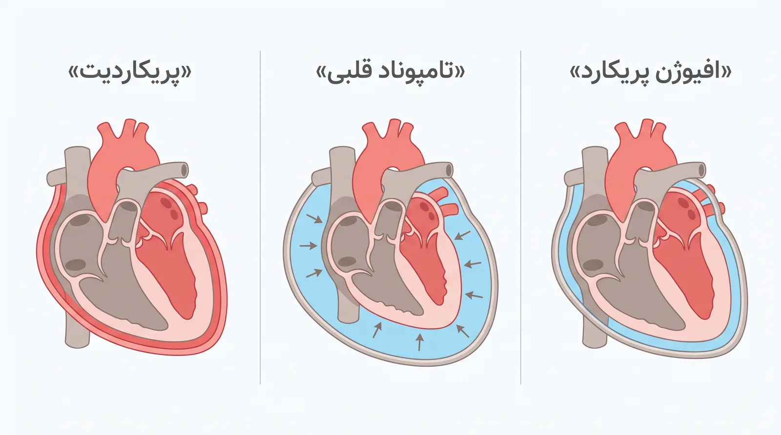 تفاوت افیوژن پریکارد، تامپوناد قلبی و پریکاردیت در یک نگاه