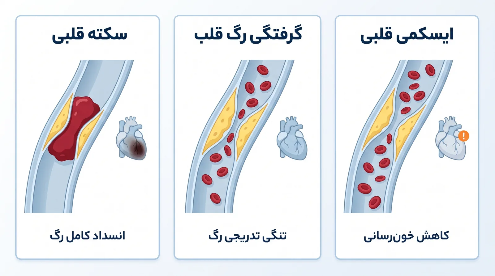 تفاوت ایسکمی قلبی، گرفتگی رگ قلب و سکته قلبی: کاهش خون‌رسانی، تنگی تدریجی رگ، انسداد کامل رگ